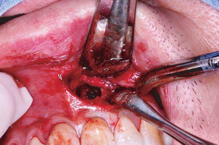 Fig. 5. Maxillary anterior cyst case.