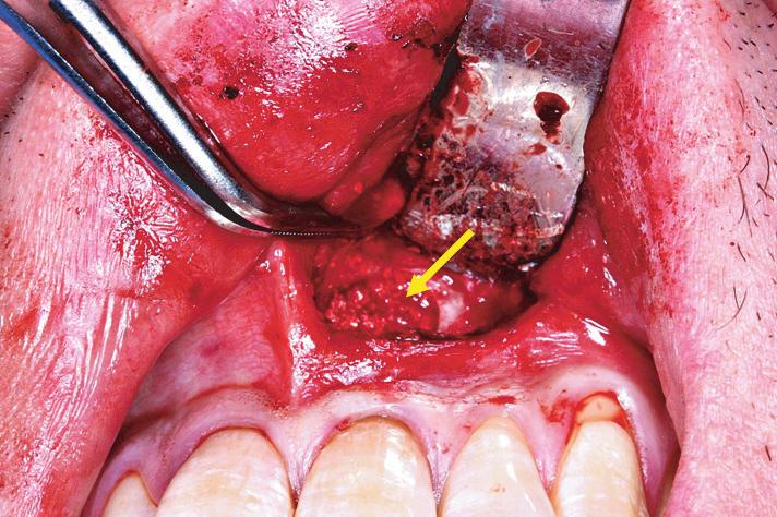 Mandibular anterior cyst case.