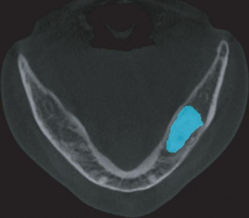 Clinical Articles Fig. 7. 1-month CT evaluation (Method A), axical cut surface (Green). 6-month CT evaluation (Method A), axial cut surface (Blue).