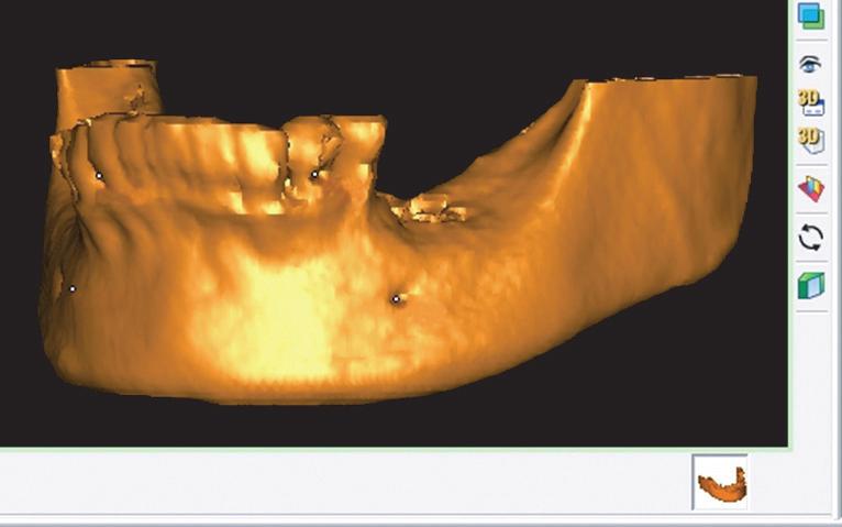 Fig. 10. Superimposition of 1-month Cone beam CT (upper left) and 6-month Cone beam CT (upper right). Superimposed 3D-model is compared of each volume.