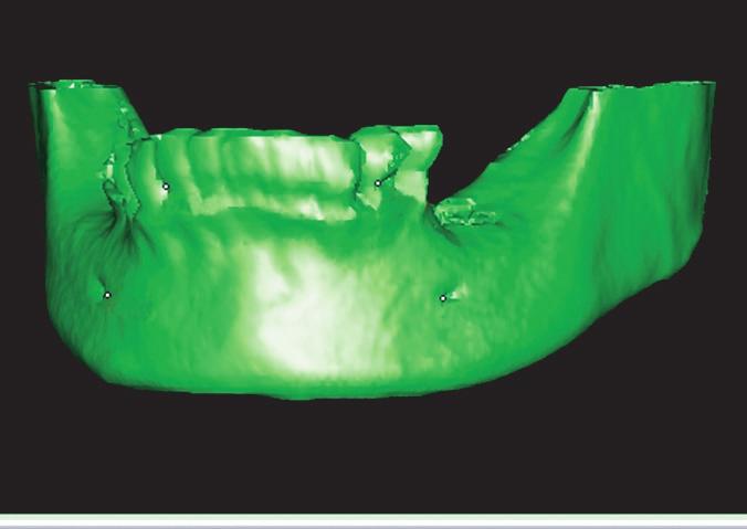 (OssPol) in Jaw Bone Defect: 3-Dimensional Volumetric Study by Simplant Software. * 잔존이식재백분율 (%)= 6개월이식재부피평균 /1개월이식재부피평균 100 자료를분석시 20명의환자에서 6개월까지평균적으로 85.