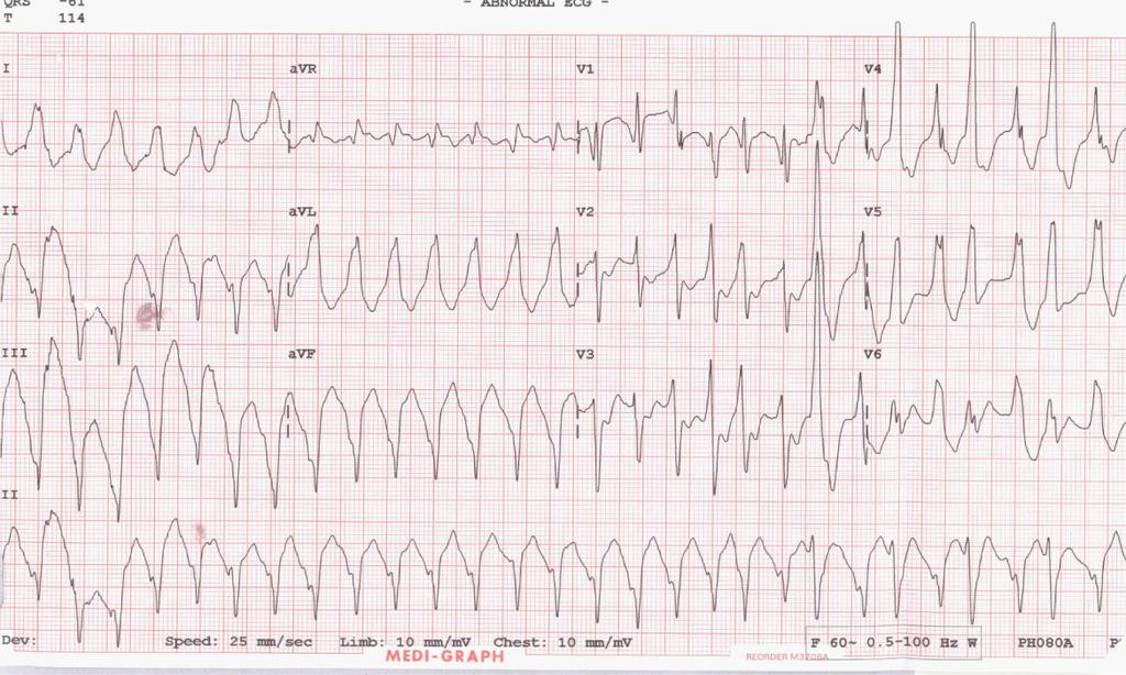 The ECG showed sustained monomorphic ventricular tachycardia with a left bundle branch block (LBBB) configuration. Society and Federation) 에서는심근병증의한형태로고려되어져야한다고결정내렸다 5,6).