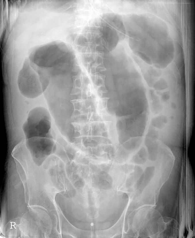 고동희 외: 독성 거대결장과 패혈증 소견을 보인 전격성 위막성 대장염 1예 Figure 1. Simple abdominal X-ray finding. It shows markedly dilated transverse colon. 11 Figure.