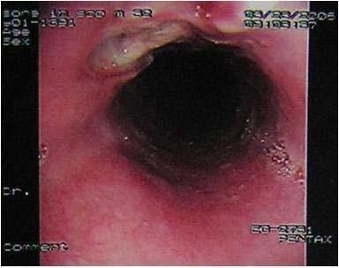 EH Park et al: A case of esophago-mediatinal fistula due to esophageal tuberculosis Figure 1.