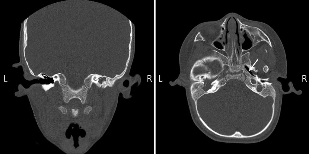 김지원 외 6인. 아가미-귀-콩팥증후군 증례 A B Figure 5. Computed tomography of the temporal bone. (A) Right external auditory canal atresia. (B) Patulous eustachian tube (arrow).