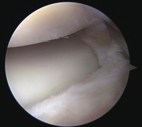 Arthroscopic view showing pathologic extensor carpi radialis brevis (ECRB) tendon and articular capsule from proximal anteromedial portal.