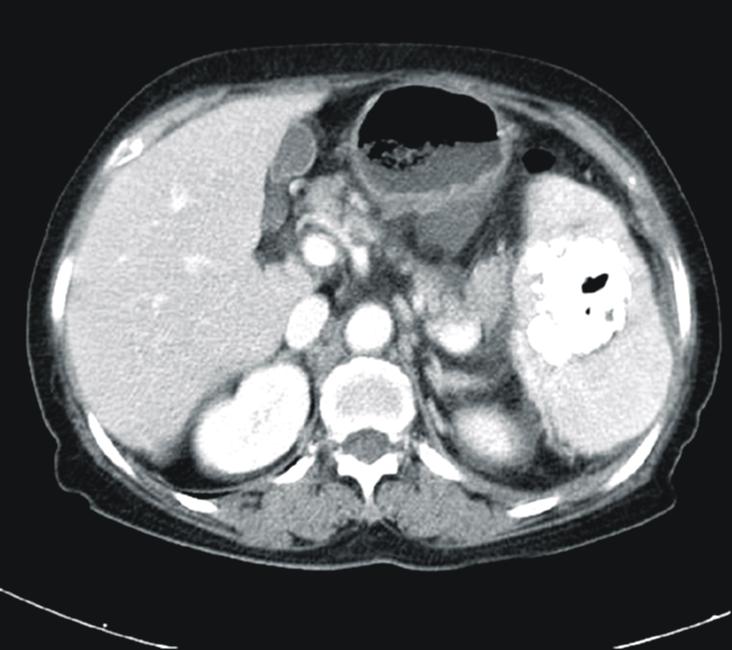The cut surface of specimen shows multiple cystic-like abscess cavity filled with pus.