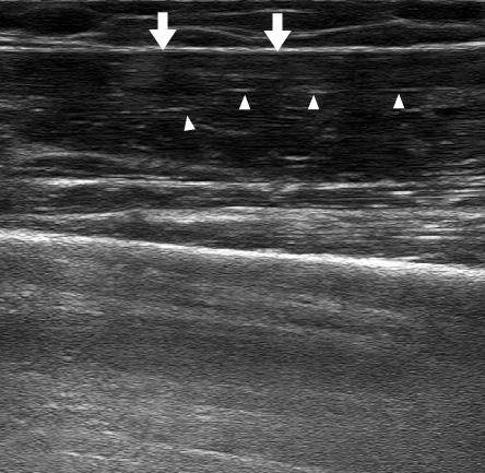 335 Figure 1. Ultrasonography (US) findings of normal skeletal muscle.