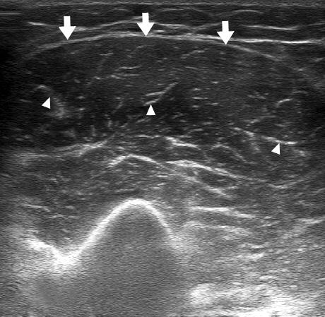 The epimysium (arrows) demarcates the outer boundaries of the muscle. H, humerus. Figure 2. Ultrasonography (US) findings of muscle contusion.