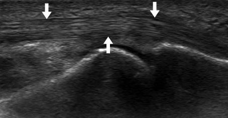 336 정웅교 이순혁 Figure 3. Ultrasonography (US) findings of a normal tendon.
