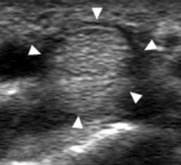 (B) Short axis US image of the flexor digitorum tendon (arrowheads) shows a homogeneous intratendinous pattern made of bright stippled clustered dots. Figure 4.