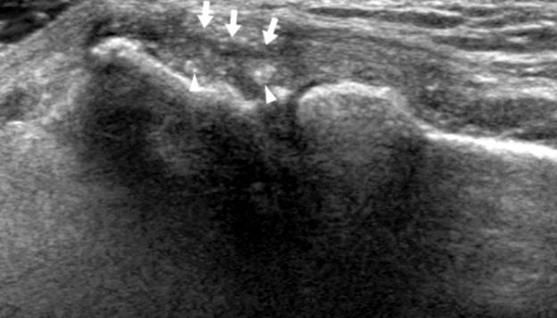 특히극상건같이건섬유의일부가사면으로뼈에부착되거나, Figure 5. Ultrasonography findings of tendinopathy.