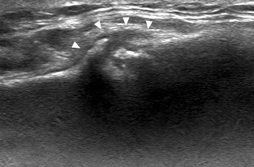 338 정웅교 이순혁 Figure 9. Plain radiographs and ultrasonography (US) findings of mid-clavicle fracture.