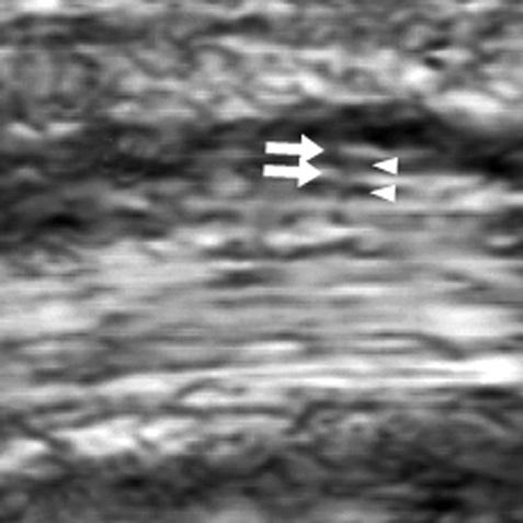 339 Figure 13. Ultrasonography (US) findings of a normal median nerve.