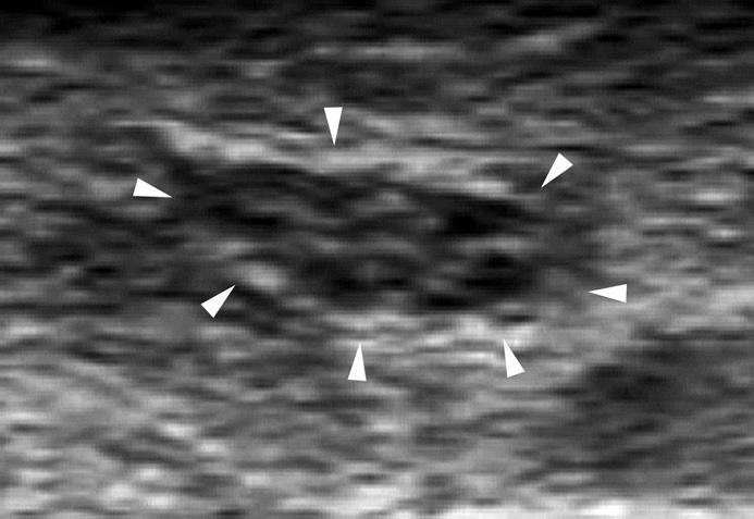 (B) Long axis US image shows the nerve fascicles appearing as elongated hypoechoic bands (arrowheads) that run parallel to each other. The internal epineurium (arrows) separates them more clearly.