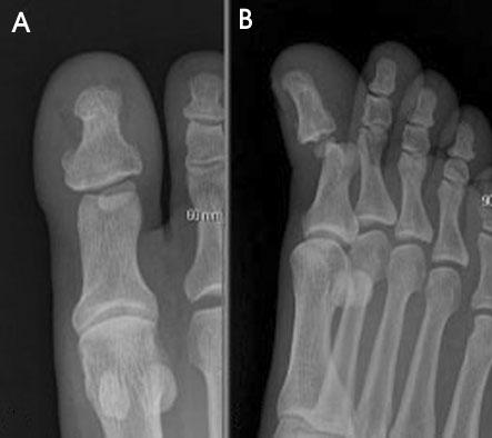 김동준 문상호 서병호 배종문 Figure 1. (A) The normal anatomy of the interphalangeal(ip) joint of a great toe. The collateral ligament locking the dislocation is not shown.