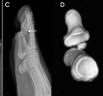 The sesamoid bone is overriding the proximal phalangeal head. The distal phalangeal bone is hyperextended and dorsal skin is depressed at the IP joint.