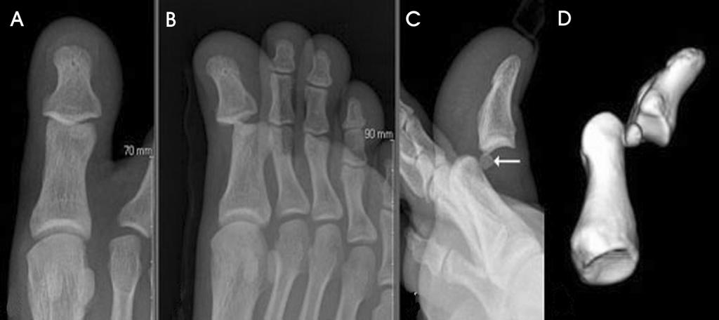 김동준 문상호 서병호 배종문 Figure 5. Preoperative radiographs and 3D-CT show interphalangeal dislocation of great toe with dorsal displacement of sesamoid.