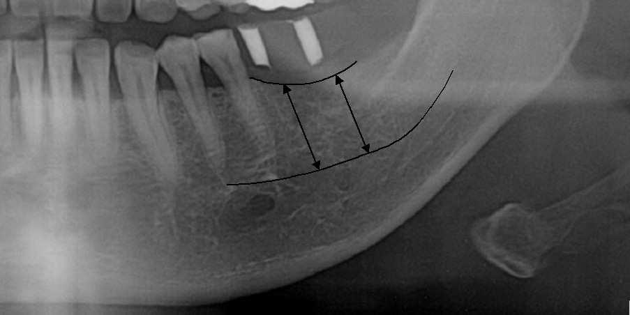 2) Measurement of the expected possible distance of implantation 1 Method 1: From the panoramic radiography The expected possible distance for implantation on the mandibular partial edentulous sites