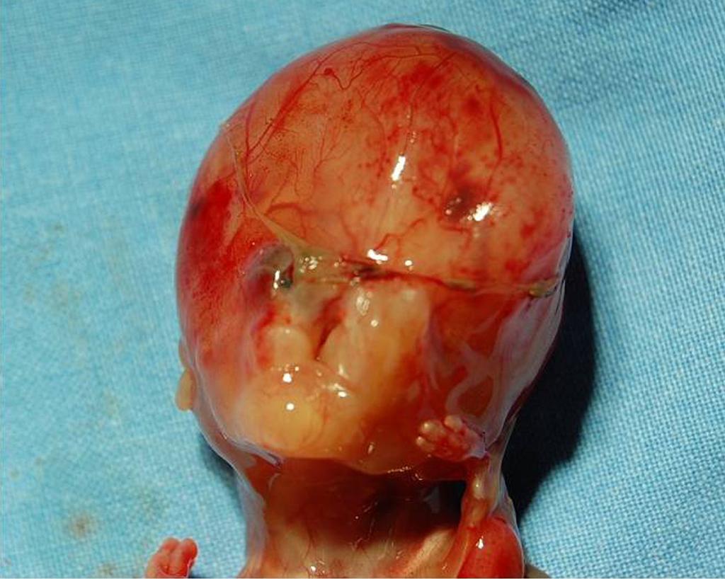 chromosome 7 (arrow). A B Fig. 4. (A) Fetus with omphalocele with herniated liver and bowel.
