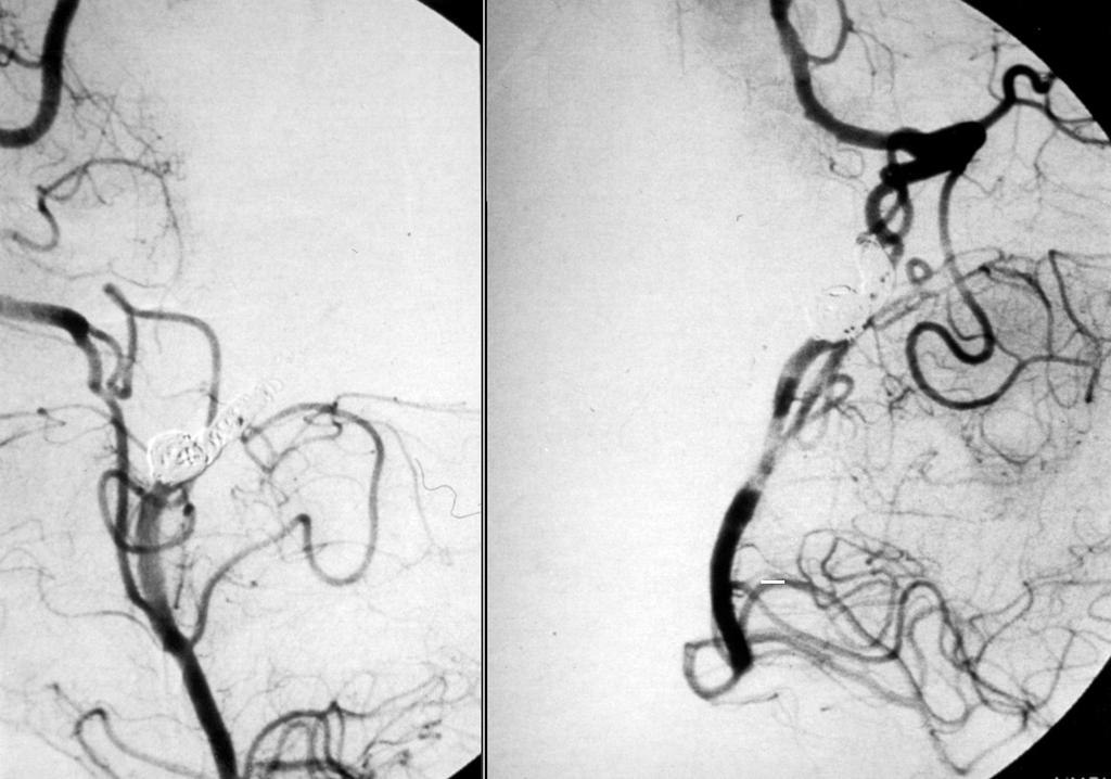 척추동맥의 박리성 뇌동맥류의 뇌혈관내 수술 A B Fig. 3. Postembolization angiogram. A Stent & GDC are seen. B Left vertebral artery is occluded completely by GDC.