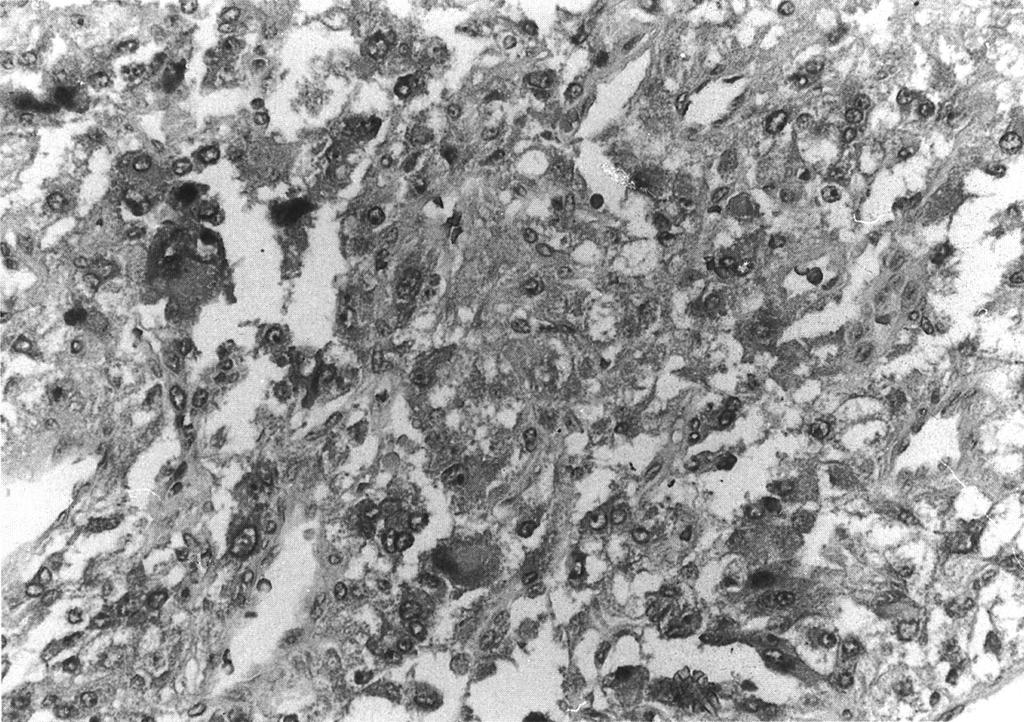 Fig. 5. Immunohistochemical stain for NSE shows cytoplasmic positivity.(nse neuron-specific enolase, 400). Fig. 6.