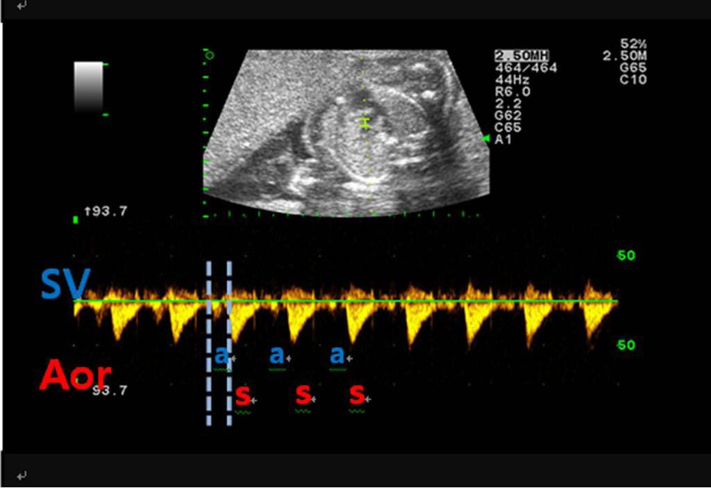 Ji Yeong Lee, et al. Prevention of congenital AV block in SLE Fig. 1. Pulsed Doppler flow curves showing normal atrioventricular relationship of cardiac rhythm.