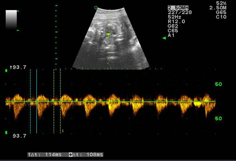 Atrioventricular time interval is the time lapse between the onsets of vena caval a-wave and aortic s-wave (between grey lines). Fig. 3. Pulsed Doppler was done at 27+1 weeks of gestation.