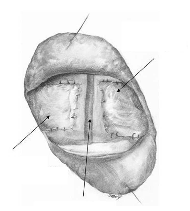 Scalp incision STparietal branch Coronal Suture Dura Left galeo (periosteal) flap Superior sagittal sinus STparietal branch Right galeo (periosteal) flap Figure 6.
