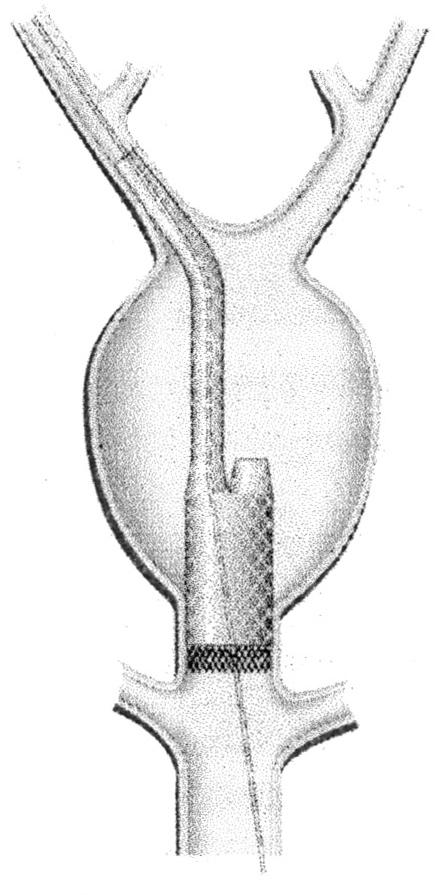 연구대상및방법 908 A B Fig. 1. Stent-Grafts used for the endoluminal treatment of infrarenal abdominal aortic aneurysms.