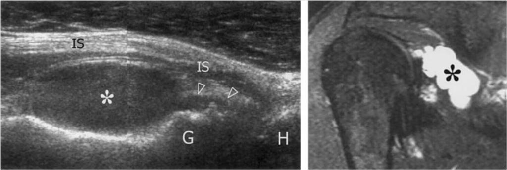 2013 년도대한통증학회추계연수교육 (a) (b) Fig. 1. Suprascapular nerve entrapment at the spinoglenoid notch.