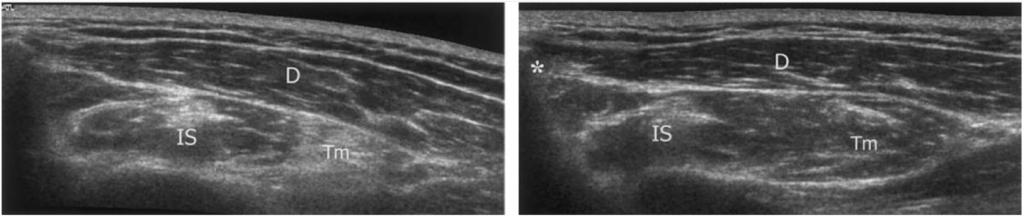 rotation of the arm. Right: No o flow signals in the PHCA were identified during hyperabduction ( 120 ) and external rotation of the arm. (a) (b) Fig. 4.