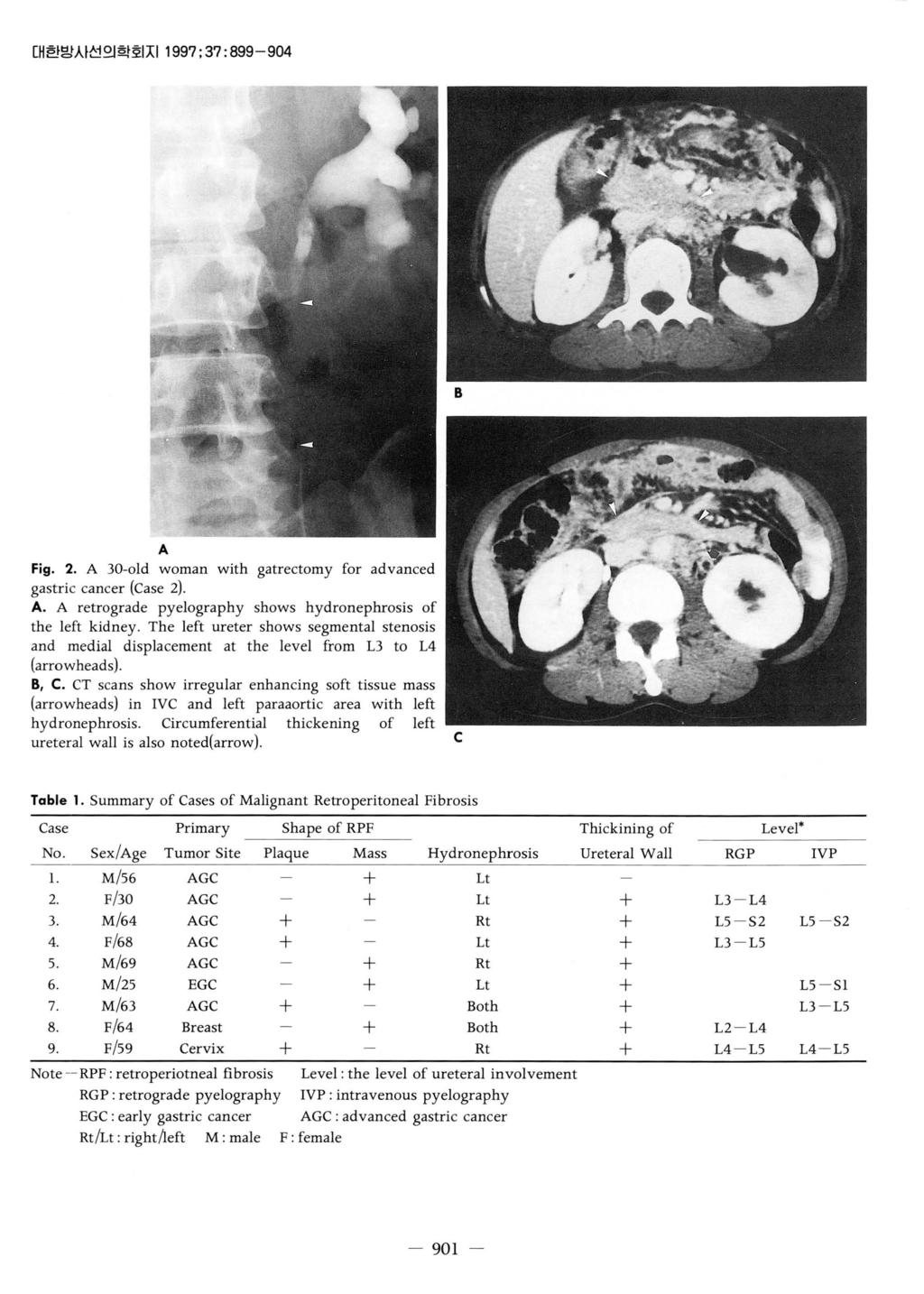 No. --대한방시선의학회지 1997: 37: 899-904 A Fig. 2. A 30-01d woman with gatrectomy for advanced gastric cancer (Case 2). A. A retrograde pyelography shows hydronephrosis of the left kidney.