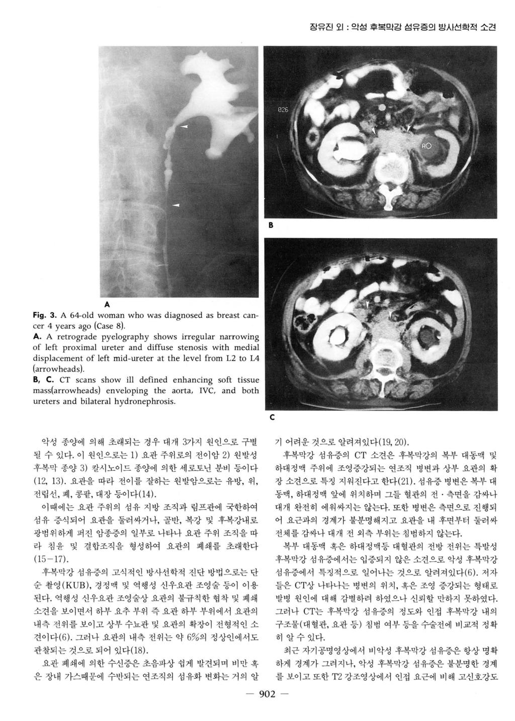 장유진오 1: 악성후복막강섬유증의망시선학적소견 Fig. 3. A 
