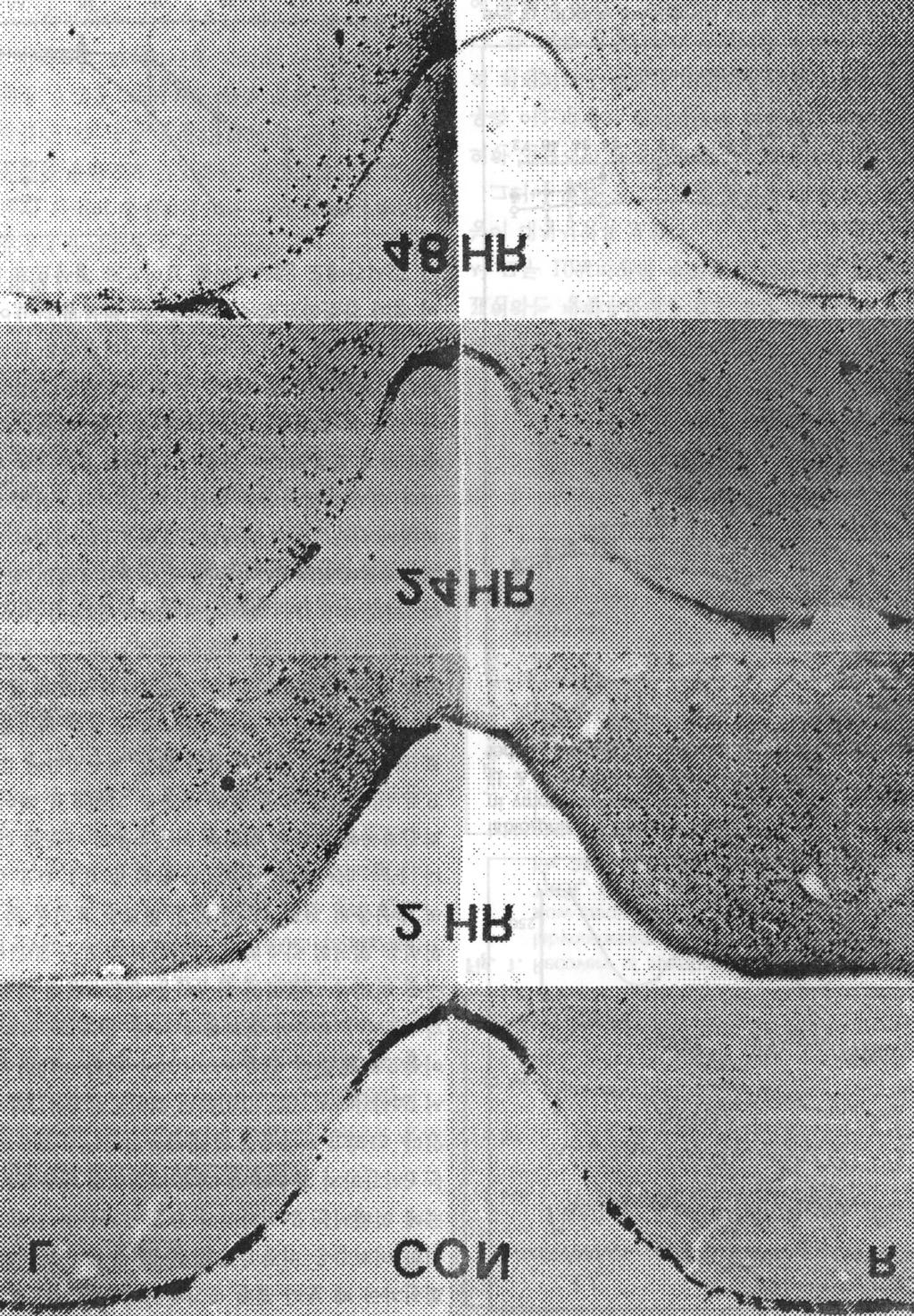 한이인지 제 4 0 권 제 5 호 1997 Fig. 6. Photographs of c-fos immunoreactive cells in the bilateral medial vestibular nuclei following left labyrinthectomy.