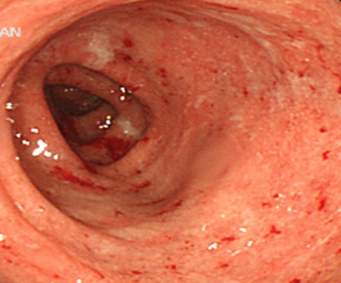 256 대한소화기학회지 : 제 56 권제 4 호, 2010 Fig. 1. Diffuse hyperemic edema, erythema, superficial ulcers with whitish exudates were observed during an initial colonoscopy (A).