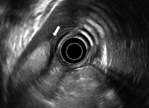 신도현외 7 인. 궤양성대장염환자에서발생한하대정맥혈전증과급성췌장염 1 예 257 Fig. 3. EUS examination and CT scan showed partially occluding thrombus (white arrows) in the IVC. Fig. 4.