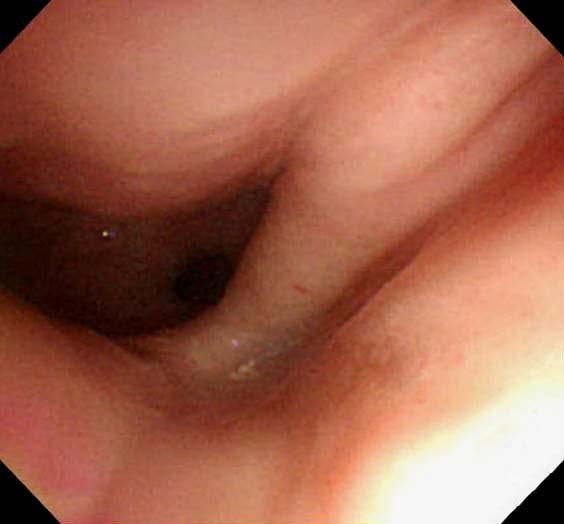 Kim SW, et al. Overtube-related Esophageal Perforation 225 Fig. 1. Endoscopic findings. (A) Endoscopic elastic band ligation for active variceal hemorrhage was performed 12 months ago.
