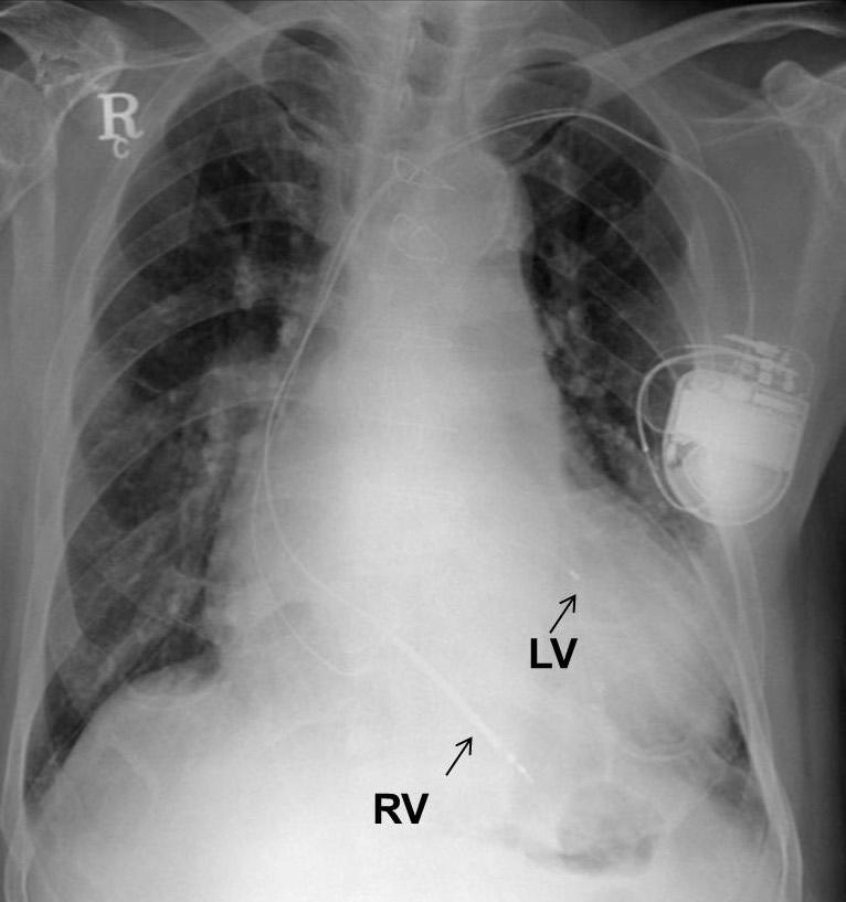 - 대한내과학회지 : 제 84 권제 3 호통권제 631 호 2013 - A B Figure 2. The chest X-ray (A) before lead extraction and (B) after lead extraction and insertion of a new implantable cardioverter defibrillator (ICD) lead.