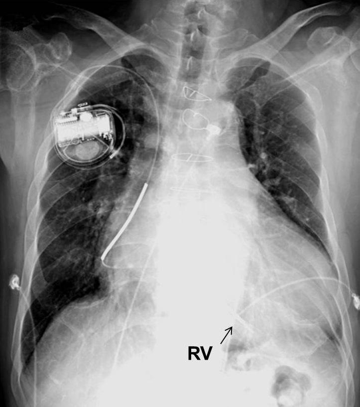 환자는지속성심방세동으로인해 CRT-D 치료의이점이많지않을것으로사료되어, 내원 14일째이식형제세동기 (implantable cardioverter defibrillator, ICD) 를우측으로삽입하였다 (Fig. 2B).