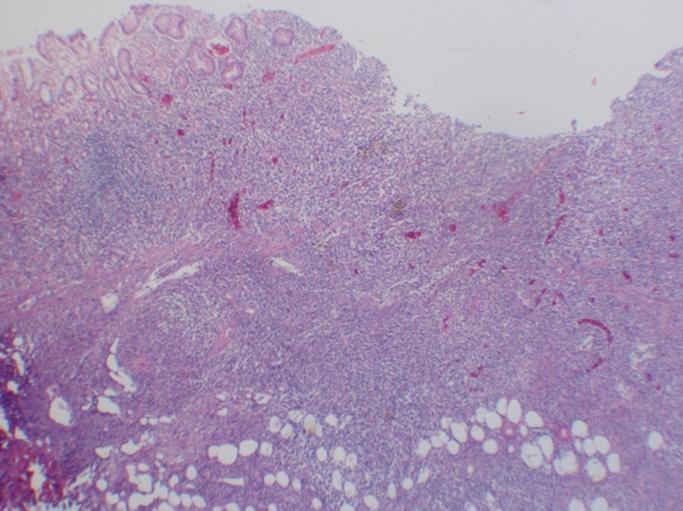 (B) It shows well differentiated adenocarcinoma with