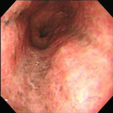 - Jae Hyoung Im, et al. Acute esophageal necrosis in diabetes - Figure 3. After 1week, follow-up gastroendoscopy shows improvement of esophageal pigmentation, mucosal edema, and ulceration.