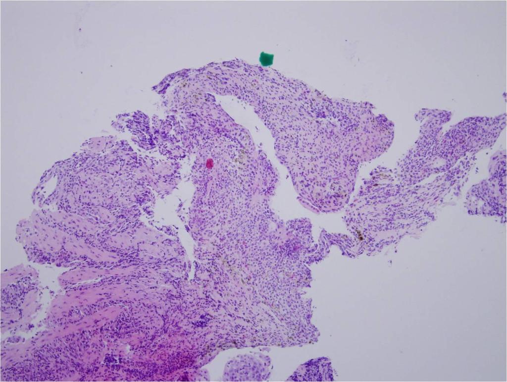 고 급성식도괴사 (acute esophageal necrosis) 는 black esophagus, acute necrotizing esophagitis 로불리기도하며이는내시경상에서의특징적인식도의검게괴사됨을특징으로한다. 이는매우드문질환으로내시경에의해발견될가능성은 0.01-0.02% 로보고된다 [1,2].
