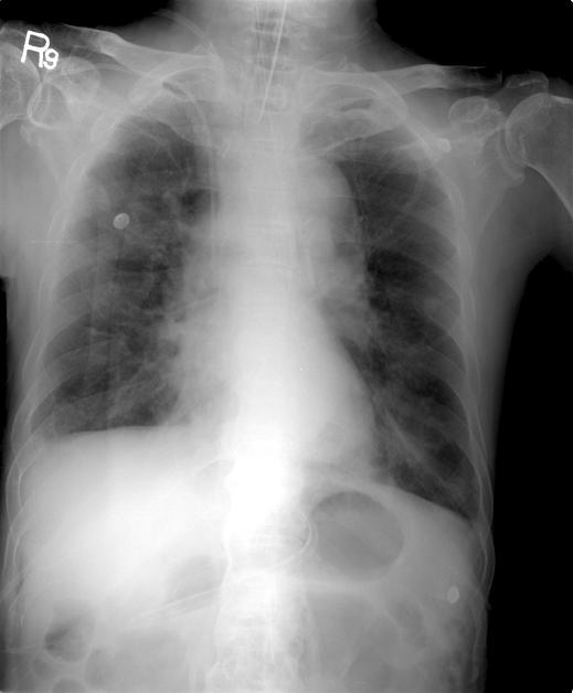 192 대한중환자의학회지 : 제 26 권제 3 호 2011 Fig. 1. Chest radiography at the time of admission in intensive care unit shows infiltration in both lower lung fields (A).