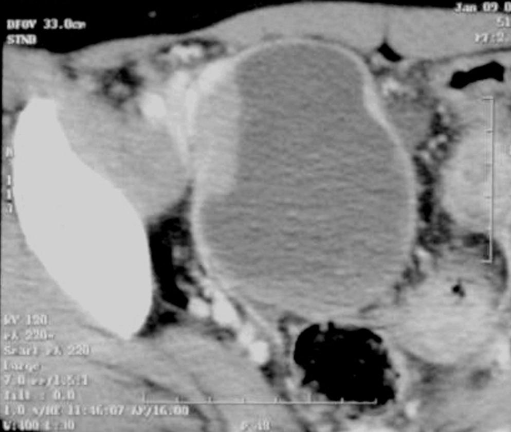 KJOG Vol. 55, No. 12, 2012 Fig. 1. A computed tomography scan shows rim-enhancing ovarian mass with solid part in pelvic cavity in patient with MayerRokitansky-Küster-Hauser syndrome.