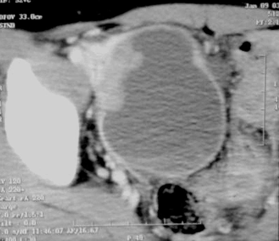 비 정상적으로 커진 임파절은 없고, 폐 전이 소견은 없었다. 우측 난소의 낭성 선암으로 추정되었다(Fig. 1). 양측 신장과 요로는 정상 소견이었 다. 복부 및 골반 CT에서 관찰되는 척추의 기형은 없었다.