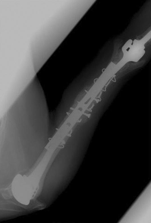 (D) Fixation using plate and screw with fibular strut allo-graft.