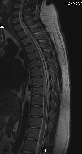 T spinal MRI showed diffuse swelling of the spinal cord and signal changes (T6-7 to T8-9; arrow).