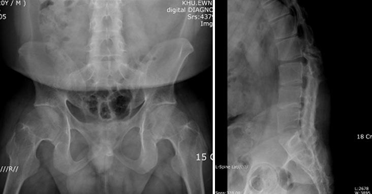 - 이재건외 5 인 : 종양괴사억제제전환과강직성척추염 - Figure 1. X-ray of the pelvis shows subchondral sclerosis and erosive changes of both sacroiliac joints. Loss of cartilage spacing in the facet joints is also seen.