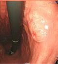 위림프종 (gastric lymphoma) 은체계적으로표준화된내시경분류법은없지만일반적으로종괴를형성하거나용종같은모습은보이는돌출형 (exophytic